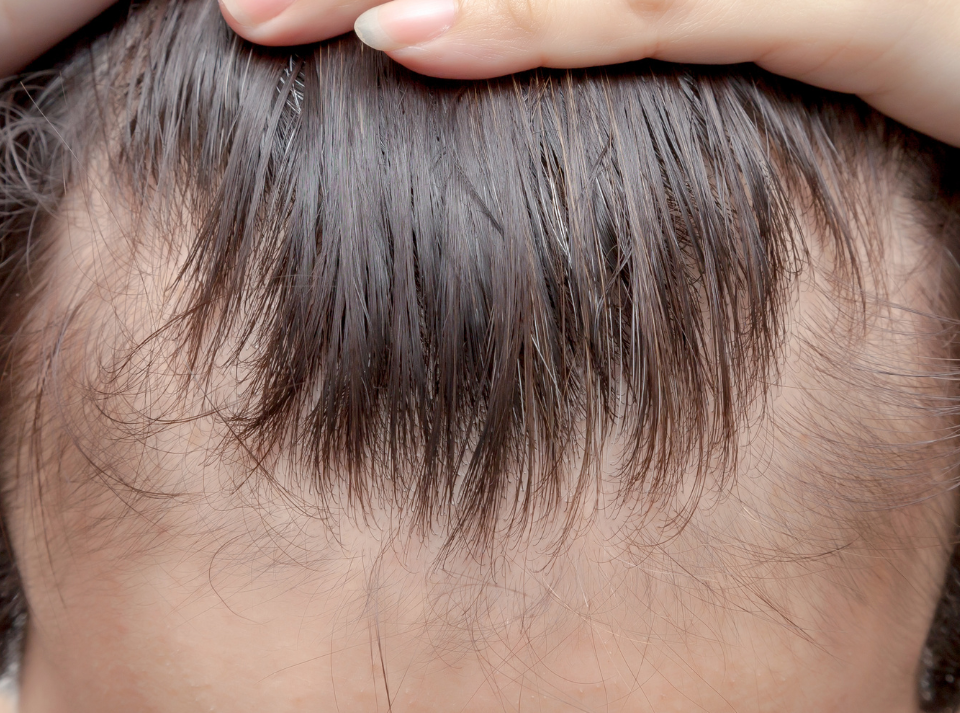 Alopecia Frontal Fibrosante