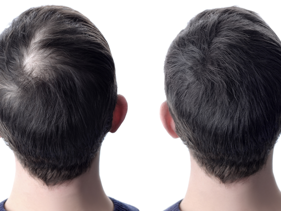 Estrés y caída del cabello: cómo el estado emocional afecta la salud capilar