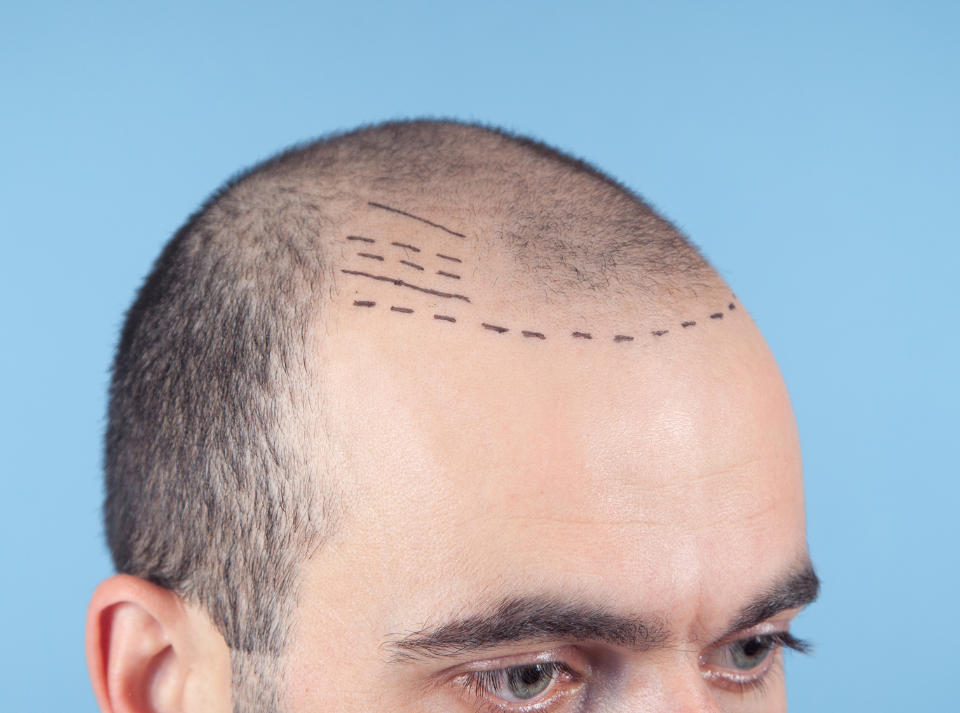 ¿Cómo se orienta el cabello en un injerto capilar? Fundamentos médicos para lograr un resultado verdaderamente natural